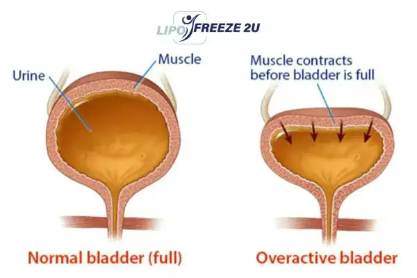diagram of overactive bladder treatment Little Bognor