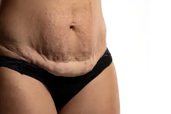 loose skin after weight loss injections Little Bognor