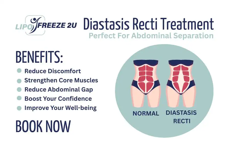 How Long Will It Take to See Improvements in Diastasis Recti Little Bognor
