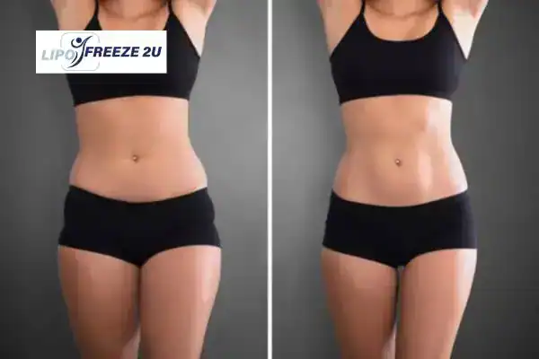 How Can LIPO FREEZE 2U Support Your Post-Pregnancy Body Recovery Little Bognor?