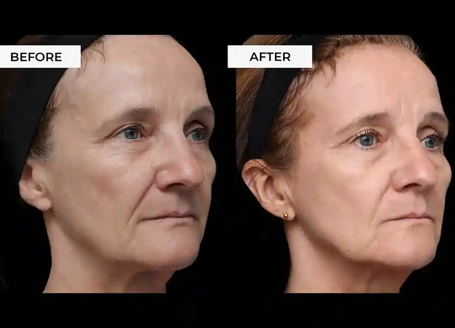 How Many RF Microneedling Sessions Will You Need to See a Difference Little Bognor?