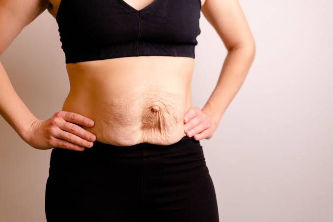 Is Surgery Really the Only Way to Repair Diastasis Recti Little Bognor?