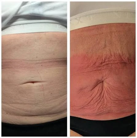 How Does RF Microneedling Improve Crepey, Thin and Uneven Skin Texture Little Bognor?