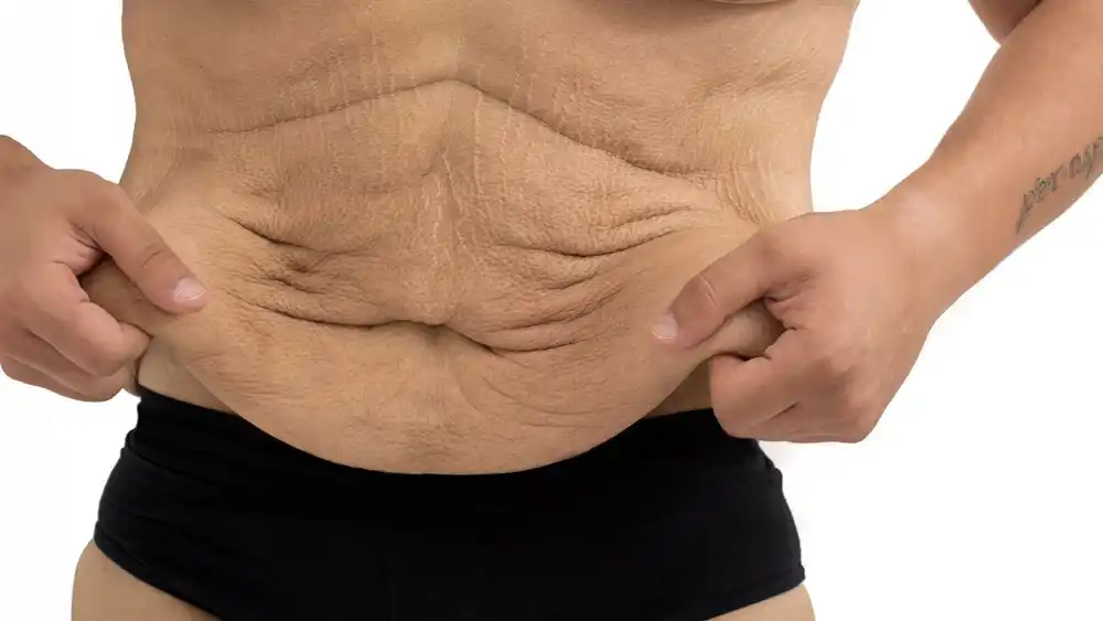 Why Does Weight Loss Medication Leave Some People With Loose or Sagging Skin Little Bognor?